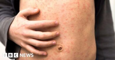 Measles warning to holidaymakers as cases rise across Europe