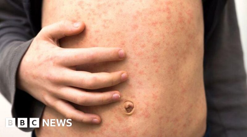 Measles warning to holidaymakers as cases rise across Europe