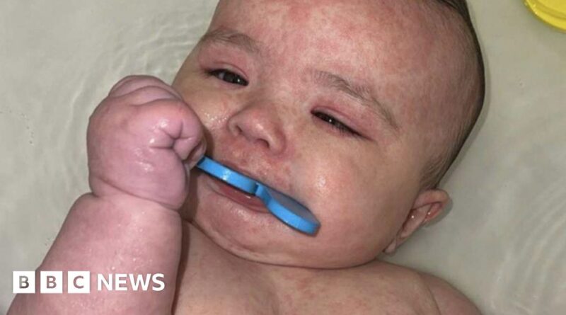 How Canada became the centre of a measles outbreak in North America