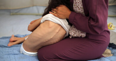 A young severely malnourished girl is helped into her clothes.