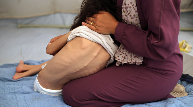 A young severely malnourished girl is helped into her clothes.