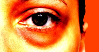 Would you spend $5,000 to remove your eye bags?
