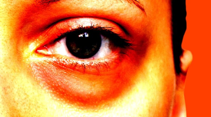 Would you spend $5,000 to remove your eye bags?