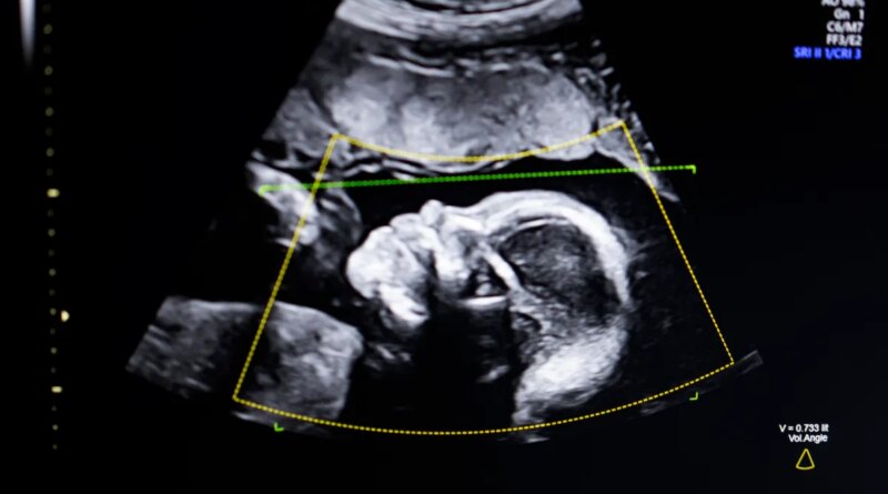 BioticsAI, which won Disrupt's Battlefield competition in 2023, gains FDA approval for its AI-powered fetal ultrasound product  | TechCrunch