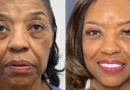 I paid $102,000 for a facelift at 71. I wish I could have done it a decade ago, but I couldn't afford it.