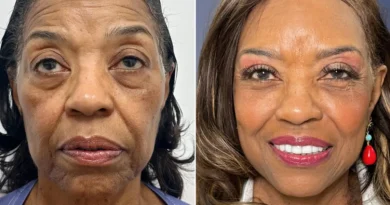 I paid $102,000 for a facelift at 71. I wish I could have done it a decade ago, but I couldn't afford it.