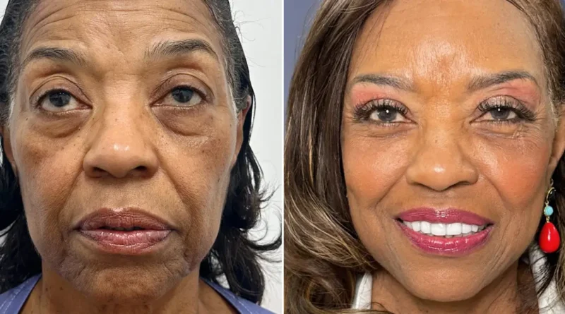 I paid $102,000 for a facelift at 71. I wish I could have done it a decade ago, but I couldn't afford it.
