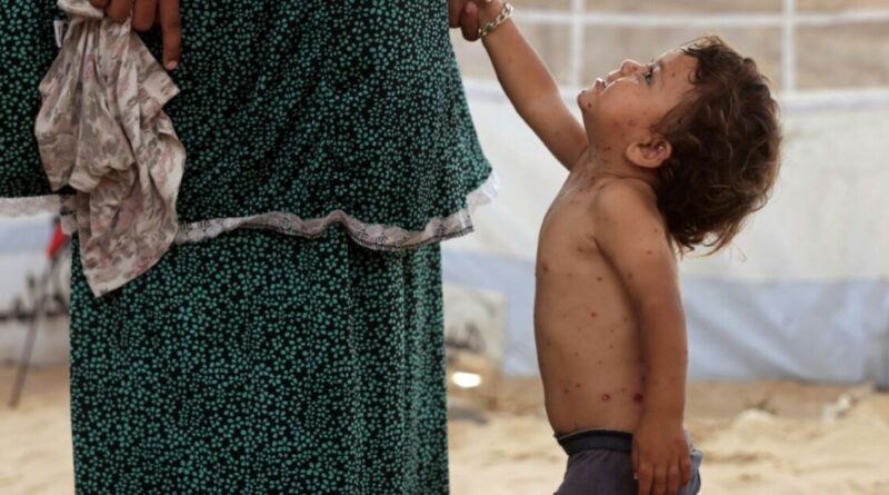 'All these rashes': chickenpox surges in Gaza camps