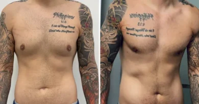Men get cosmetic surgery, too. I spent $14,000 on plastic surgery, and I don't regret it.