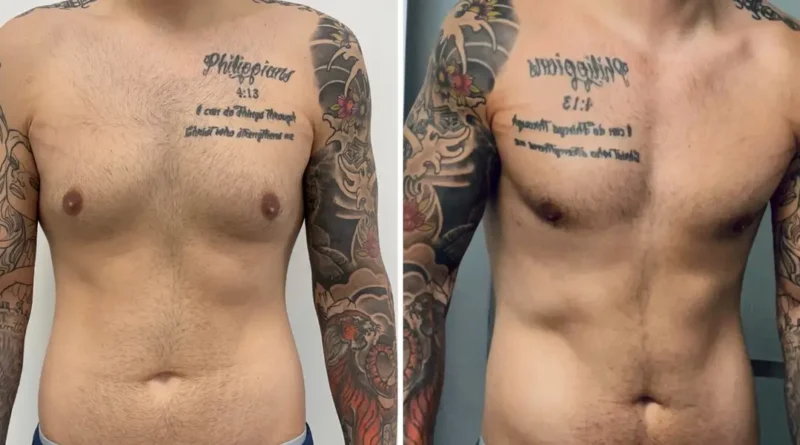 Men get cosmetic surgery, too. I spent $14,000 on plastic surgery, and I don't regret it.