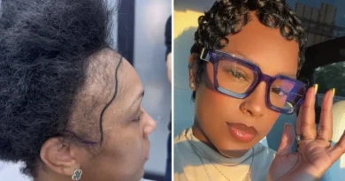 I couldn't afford a $13,000 hair transplant in the US. So I flew to Turkey and I love the results.