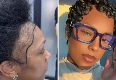 I couldn't afford a $13,000 hair transplant in the US. So I flew to Turkey and I love the results.