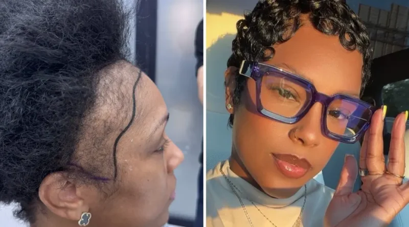 I couldn't afford a $13,000 hair transplant in the US. So I flew to Turkey and I love the results.
