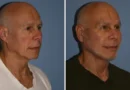 I'm a 72-year-old grandfather and spent $60,000 on a facelift and other cosmetic procedures. People now think I'm in my 50s.