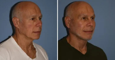 I'm a 72-year-old grandfather and spent $60,000 on a facelift and other cosmetic procedures. People now think I'm in my 50s.
