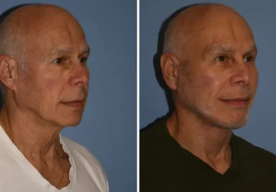 I'm a 72-year-old grandfather and spent $60,000 on a facelift and other cosmetic procedures. People now think I'm in my 50s.