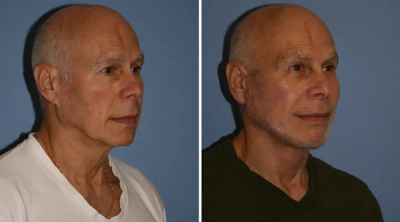 I'm a 72-year-old grandfather and spent $60,000 on a facelift and other cosmetic procedures. People now think I'm in my 50s.